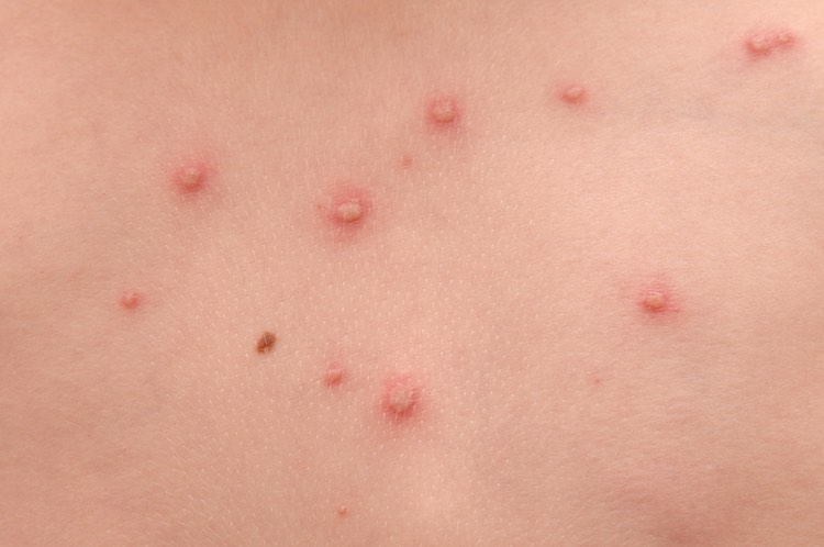 chickenpox in adults