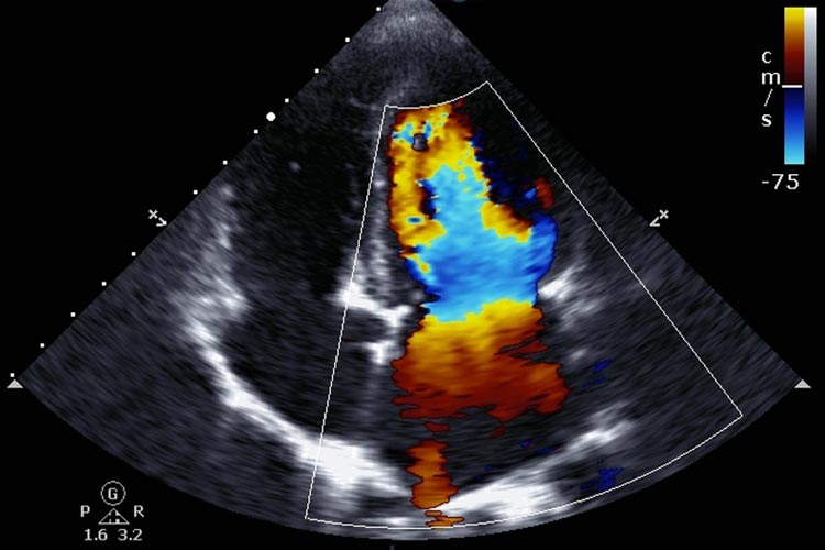 Cardiomyopathy