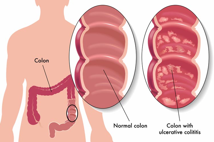 ulcerative colitis mucus in stool