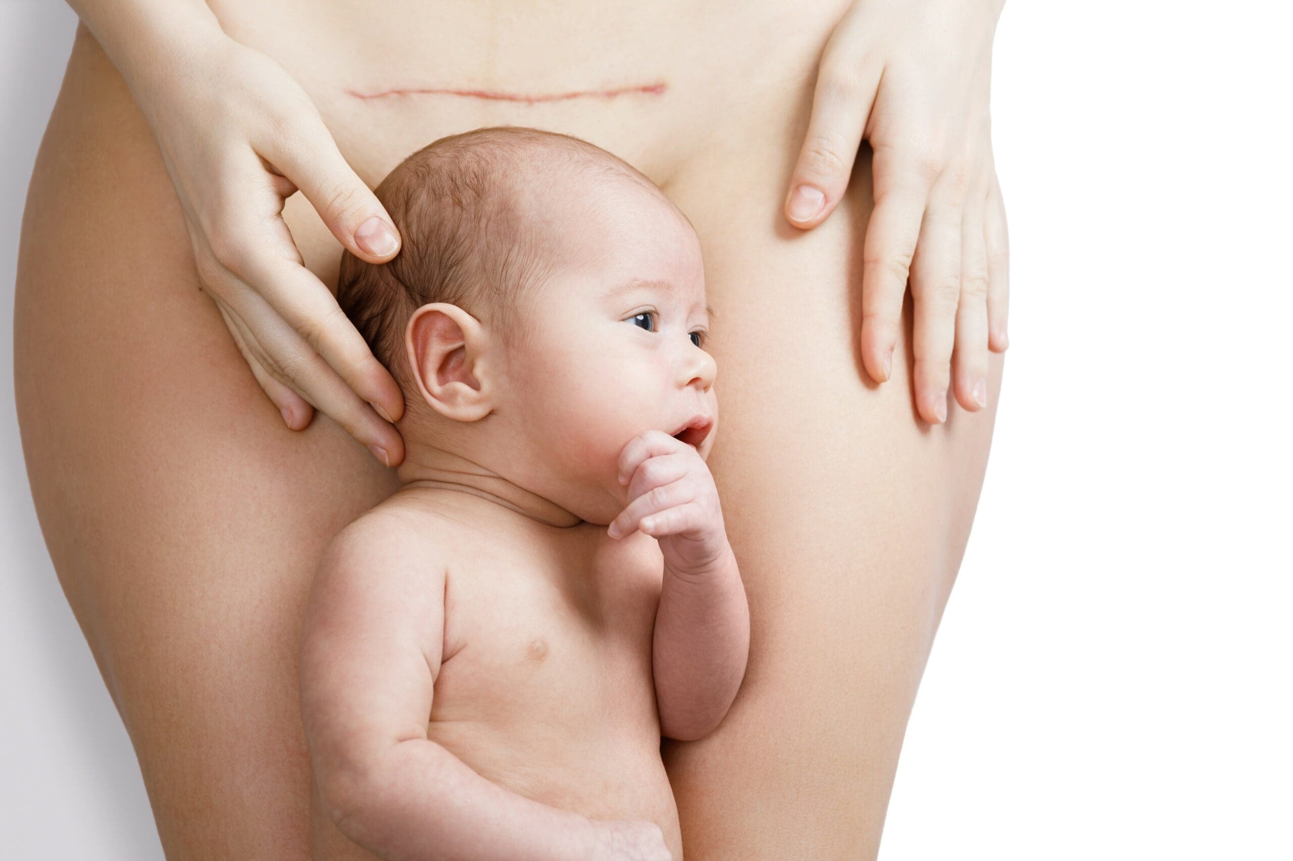 Is there a link between caesareans and autism?