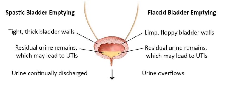 Urine flow of a Spastic or Flaccid Bladder with normal or low sphincter tone