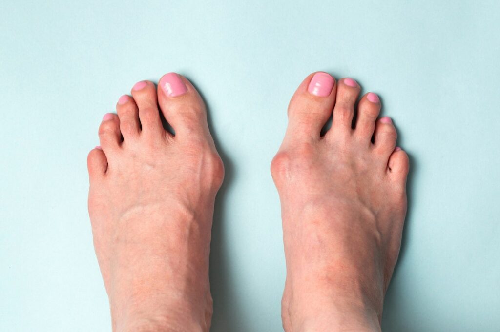 Toe Bunion Corns Gout Arthritis Foot Pain Support 